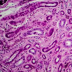 purple-stained micrograph showing diffuse proliferative glomerulonephritis