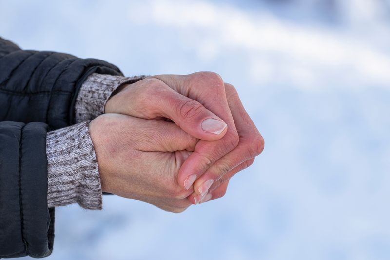 Frostbitten hands