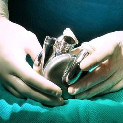 Photograph of the shiny titanium BiVACOR® Total Artificial Heart, grasped by two white latex-gloved hands, resting on a turquoise sheet