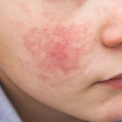 close up of boy with red cheeks