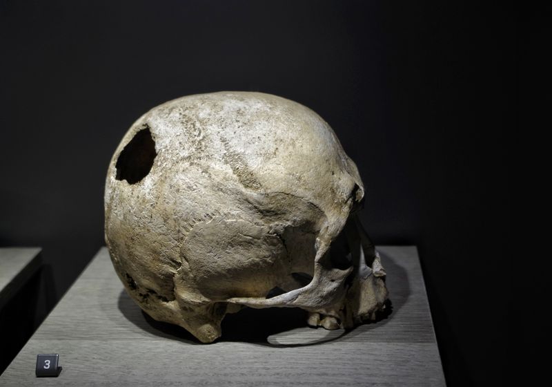 skull with a borehole, evidence of trepanation